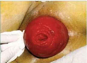 Ⅱ度：完全性直肠脱垂，不合并肛管脱垂。